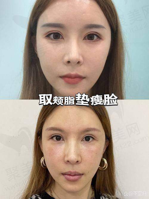 一、脂肪全脸填充术的基本概念