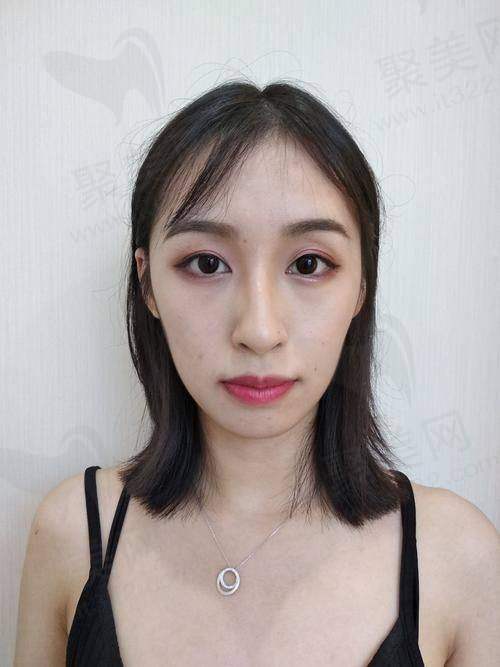 十、脂肪全脸填充术的注意事项