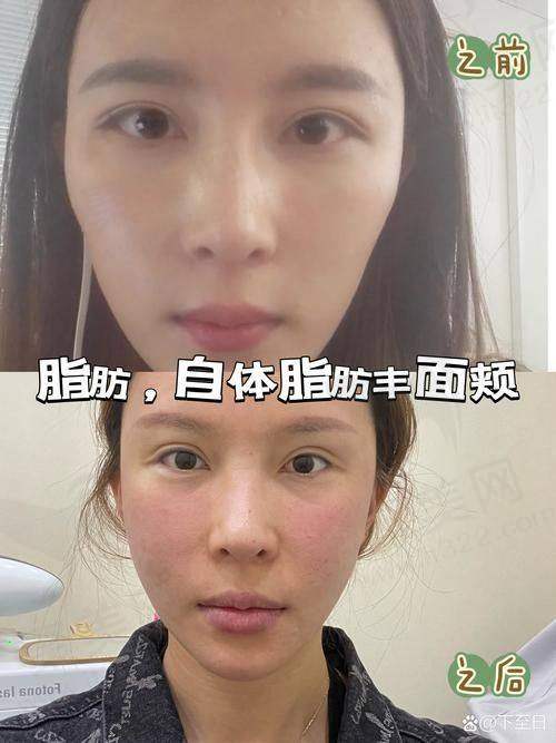 九、脂肪全脸填充术的实例分享——桑建波医生