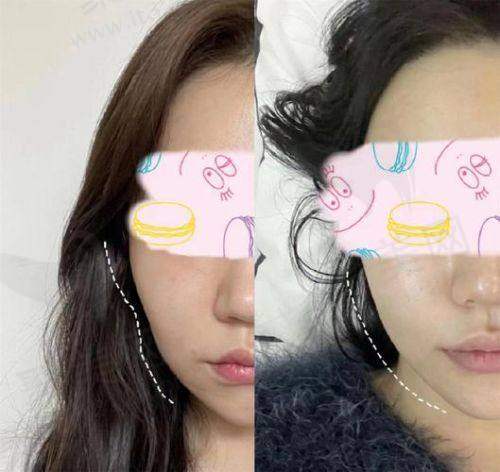 三、脂肪全脸填充术的美学设计