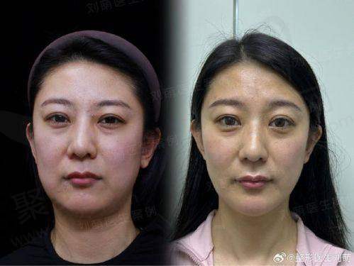 四、脂肪全脸填充术的手术过程