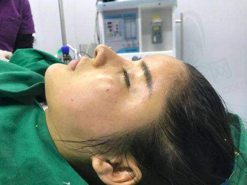 八、脂肪全脸填充术的风险控制