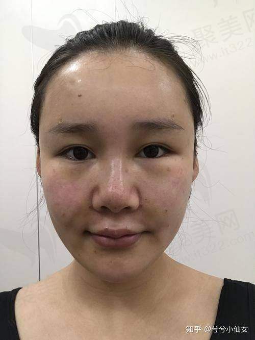七、脂肪全脸填充术的护理重点