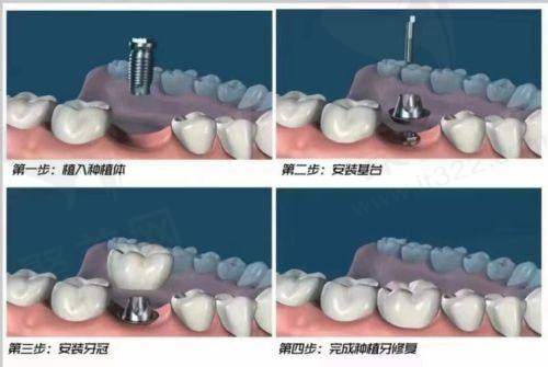 六、选择种植牙的注意事项