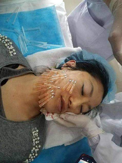 重庆星荣整形快翎线苹果肌埋线提升价格及优惠活动