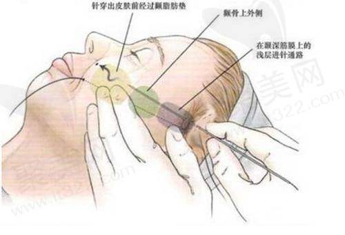 重庆星荣整形快翎线苹果肌埋线提升作用