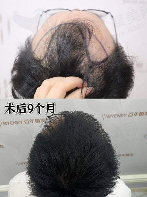 三、丰富的植发项目