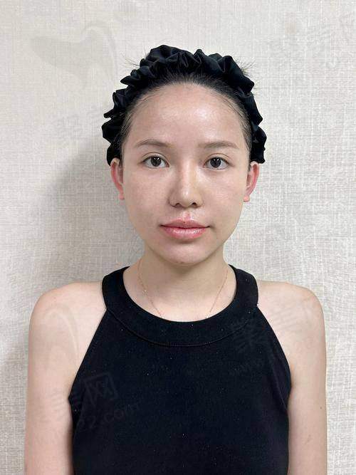 三、注射玻尿酸的美学建议