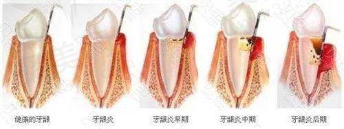 西安团圆口腔医院牙周炎龈下刮治价格200元起，微创精准还促进愈合超划算