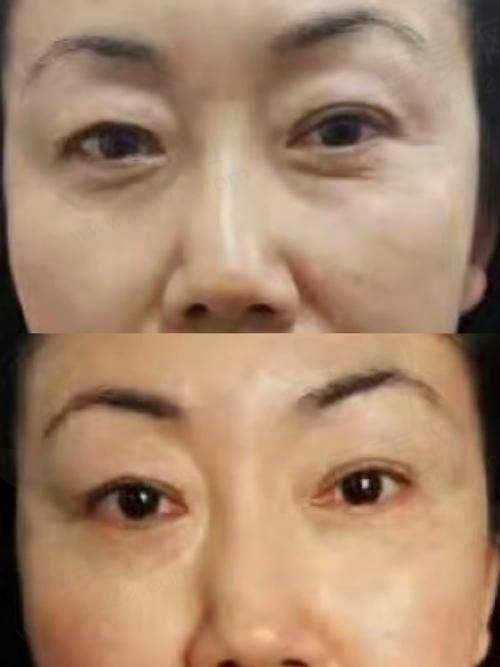 四、眼部泪沟填充之费用揭秘
