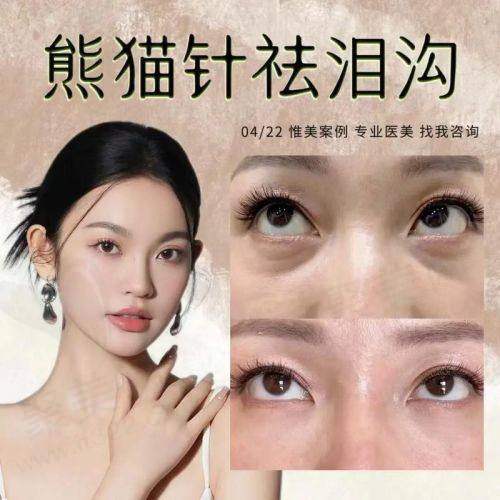 三、眼部泪沟填充之手术过程及体验