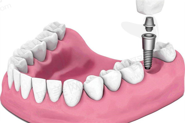 上海鼎植口腔连锁价格表都有啥？种植牙、矫正、镶牙等项目收费全揭秘