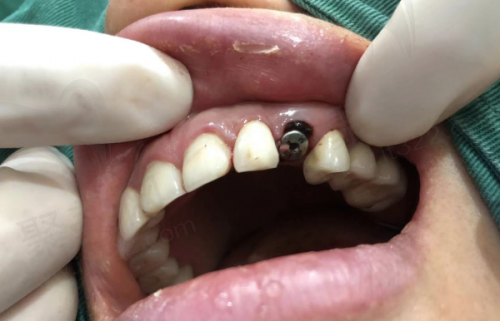 患者在肖林喜医生这里种牙的体验如何？