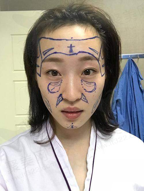 一、脂肪填充脸部价格的大致范围