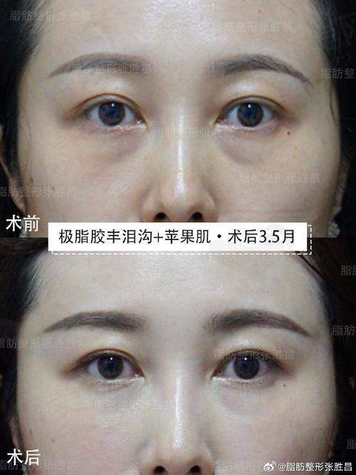 二、影响脂肪填充脸部价格的因素