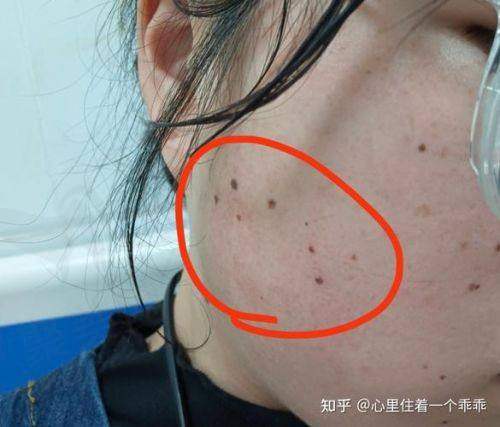 乌鲁木齐华美整形二氧化碳激光祛痣原价100元/颗，现50元起美肤不留痕！