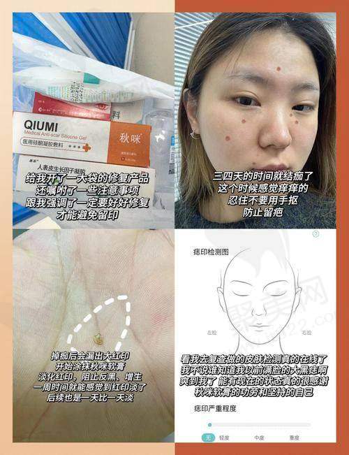 乌鲁木齐华美整形二氧化碳激光祛痣的作用与成效