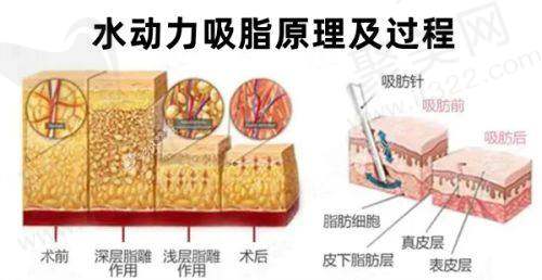 诺美德整形隆鼻价格