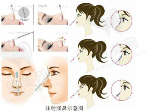 深圳八大处整形医院隆鼻价格