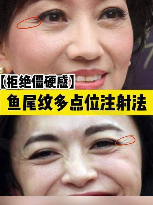 杭州浮想国医疗美容鱼尾纹国产注射除皱原价3000元.现4999元起成效好护理贴心