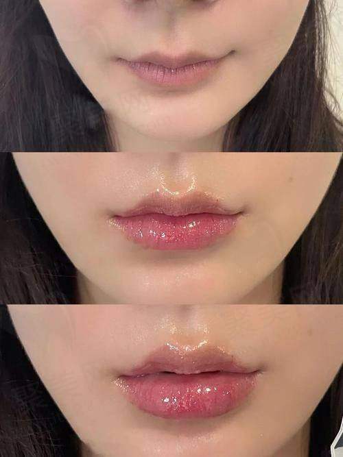 广州荔医医美做姣兰玻尿酸1mL嘟嘟唇的医生怎么样?