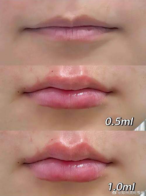 广州荔医医美姣兰玻尿酸1mL嘟嘟唇成效如何?