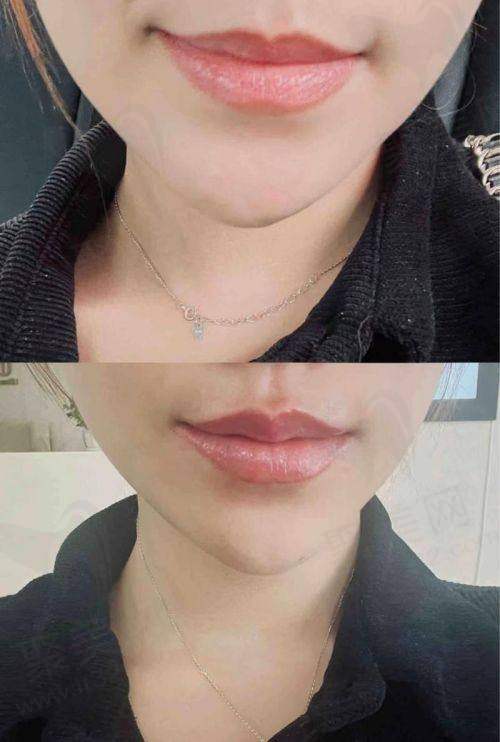 广州荔医医美姣兰玻尿酸1mL嘟嘟唇1980元起,刘博医生打造持久自然美唇超惊喜