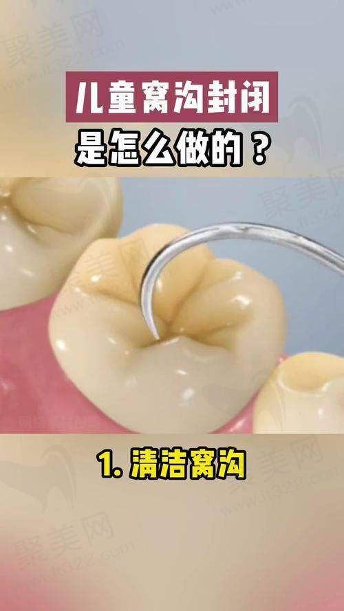 西安团圆口腔儿童窝沟封闭项目的作用