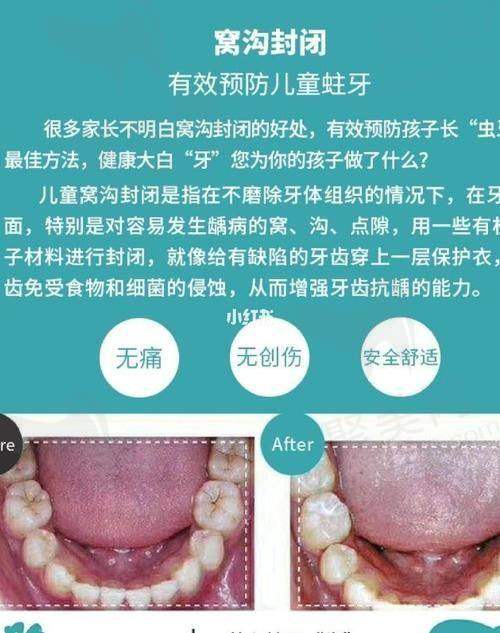 西安团圆口腔儿童窝沟封闭的适用人群