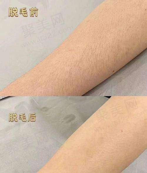 杭州浮想国医美比基尼V区私密脱毛的优惠活动详情