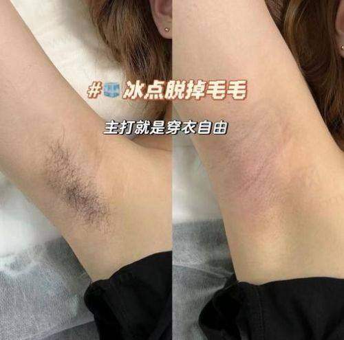 杭州浮想国医美比基尼V区私密脱毛的作用和好处
