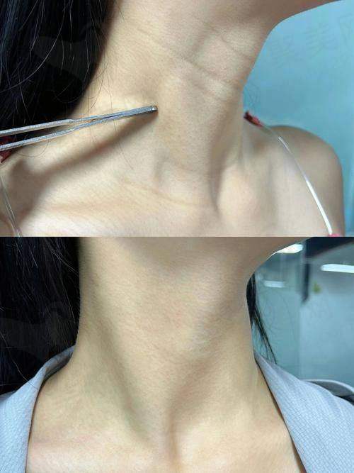 广州荔医医美嗨体1.5mL+嗨体2.5mL去颈纹套餐采用的技术有什么优势?