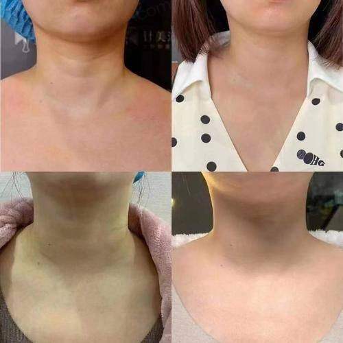 广州荔医医美嗨体1.5mL+嗨体2.5mL去颈纹套餐1680元起,合规产品快速去纹超划算!