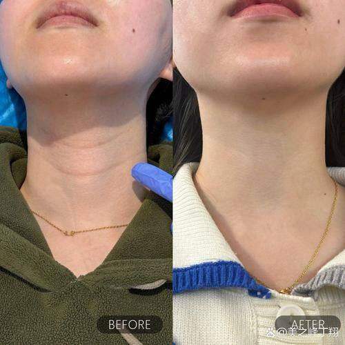 广州荔医医美嗨体1.5mL+嗨体2.5mL去颈纹套餐中的产品怎么样?