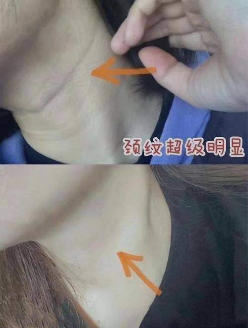 广州荔医医美嗨体1.5mL+嗨体2.5mL去颈纹套餐适合哪些人?