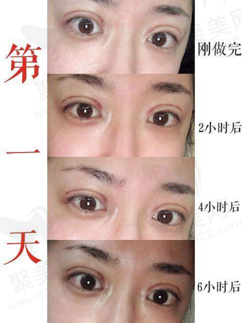 南宁亚太陈晓君医生的真实的患者评价如下：