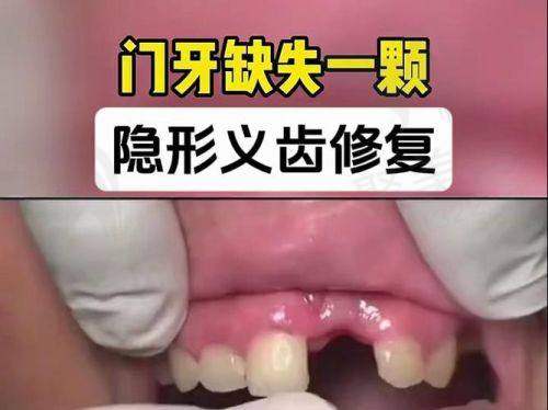 长春传阳口腔老人全口假牙合作品牌多样