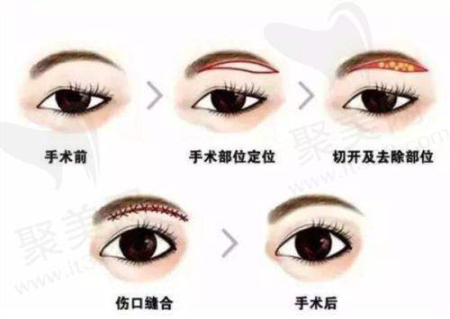 一、北京黄寺整形医院眼部整形项目价格及特色