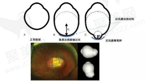 青岛华厦眼科医院全飞秒激光手术还有其他相关费用吗？