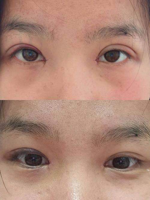 广州荔医整形开内眼角双侧采用了什么技术?