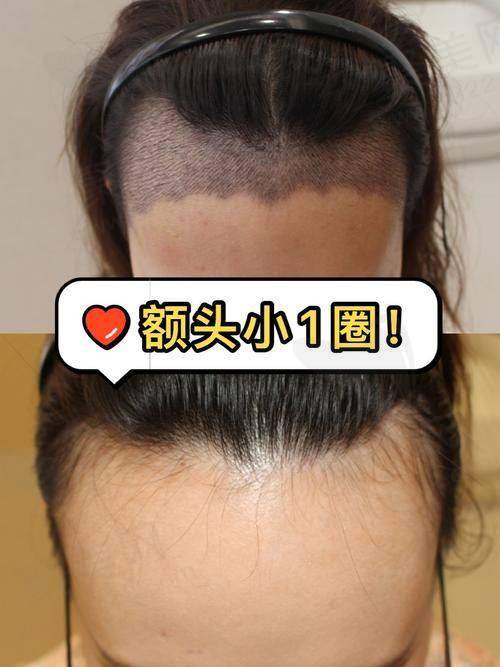 广州荔医整形种植发际线2500单位价格9500元起推荐刘斌医生,先进技术助你速享浓密自然发际线