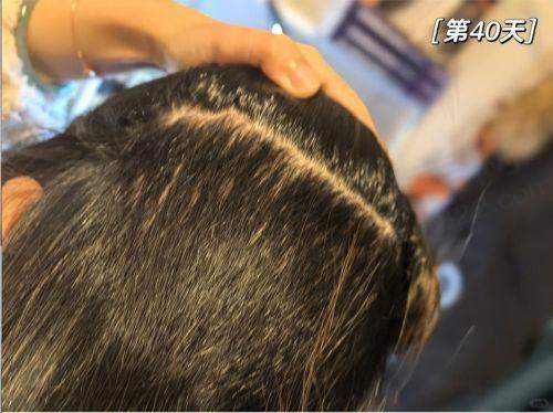 广州荔医整形种植发际线采用了什么技术?