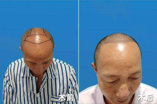 推荐的刘斌医生实力怎么样?