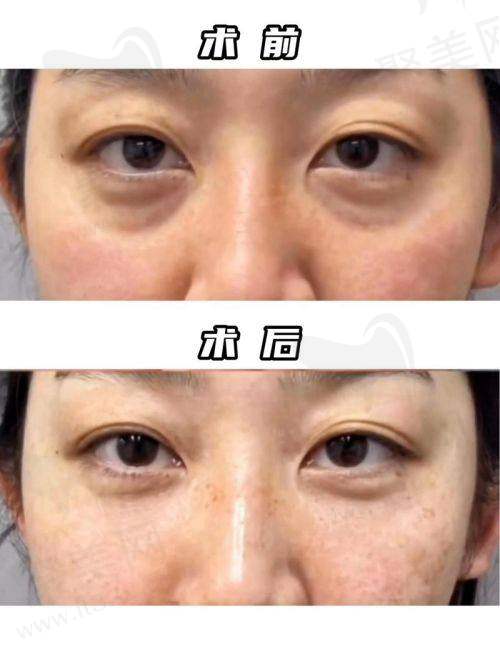 广州荔医医疗美容内切祛眼袋价格3999元起,曾德浩医生操刀恢复快效果自然超安心
