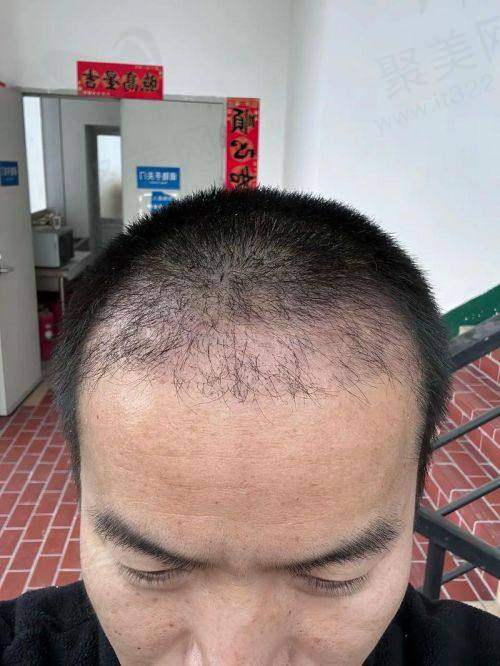 五、常见脱发问题解答