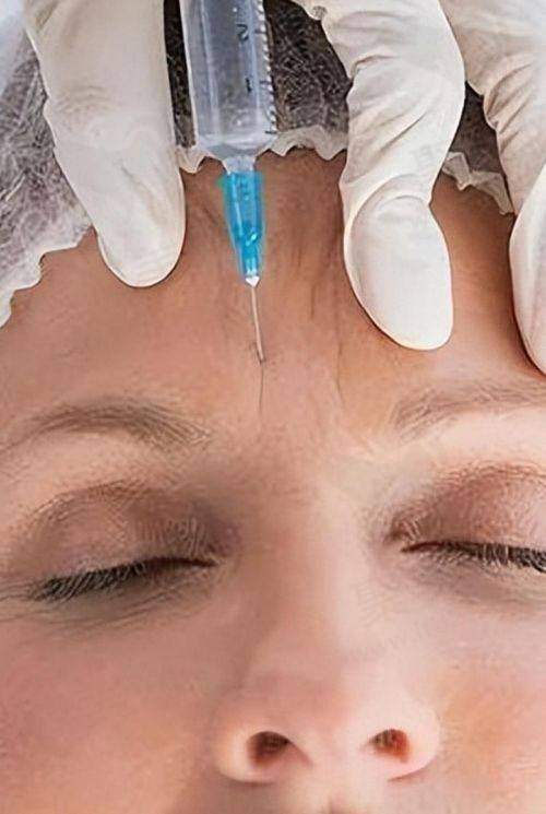 广州荔医医疗美容川字纹国产除皱针780元起,微痛精准还定制快和川字纹说拜拜