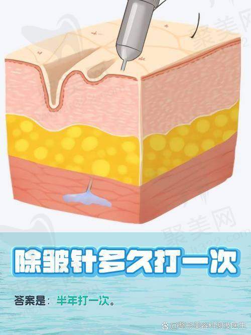 广州荔医医疗美容川字纹国产除皱针使用的产品怎么样呢?