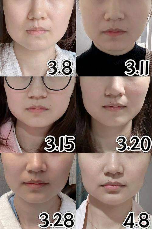 广州荔医整形国产瘦脸+下颌缘提升880元起,优质产品与贴心服务助你轻松变美