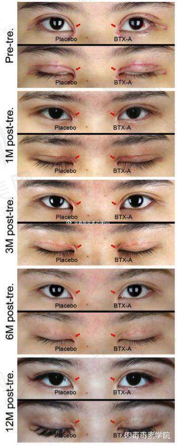 广州荔医整形开内眼角双侧价格3800元起,微创无痕增大眼型提升气质实现美丽蜕变