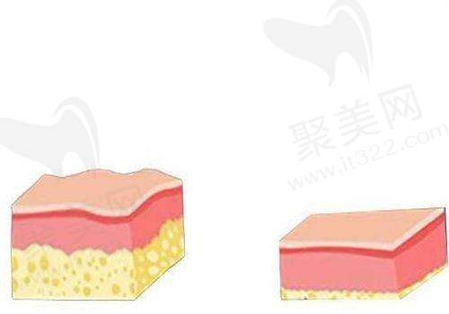 深圳今喜医疗美容吸脂技术如何？正规资质、先进技术与成功案例全方位揭秘 